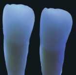 Naturlig lag-teknik Ny opaliserende emaljefarve Ny super-light dentinfarve