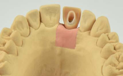 Você pode criar um modelo anatômico reduzido ou de contorno total, dependendo das indicações do material odontológico utilizado.