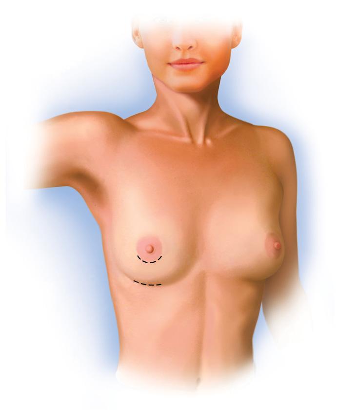 Der kan være flere grunde til, at du ønsker at få fjernet dine brystimplantater.