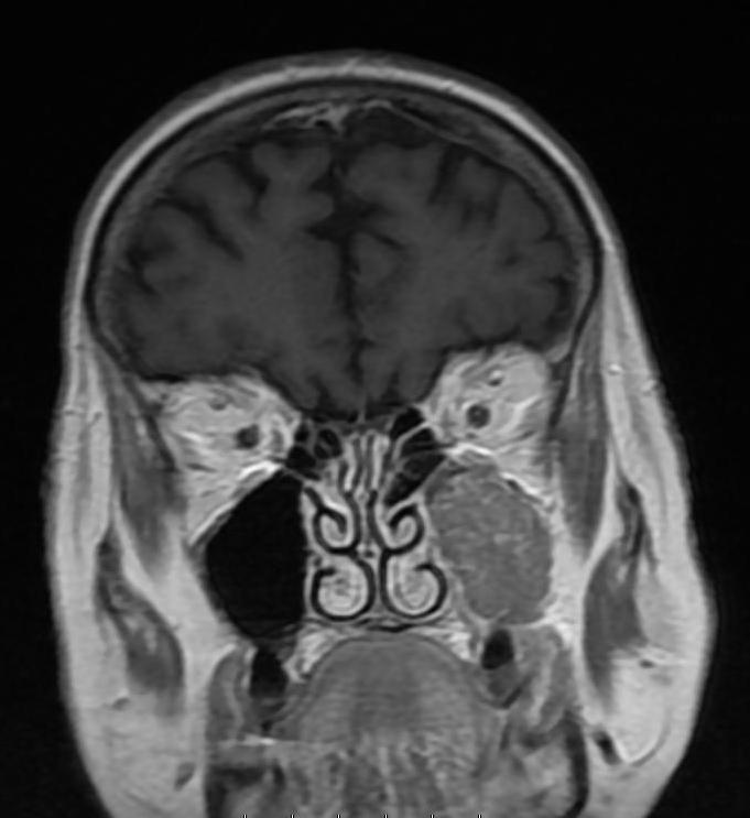 Coronal MR-scanning image showing complete filling of both maxillary sinuses in an eighteen-year-old female with acute sinusitis. B.