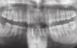 Intraoral, periapical radiograph regio +1 (same patient as in Fig. 6A) showing clearly presence of a»mesiodens«(arrows).