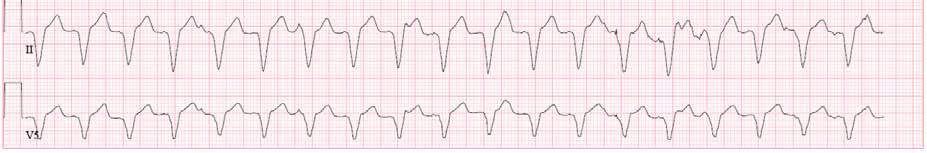 What is the diagnosis? 1. Atrial fibrillation 2.