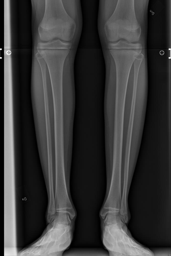 HKA optagelse (Hip/knee/ankle eller hofte/knæ ankel optagelse), giver et