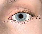 Mulige bivirkninger og komplikationer Ar Arrene placeres, så de følger de naturlige linjer omkring øjnene.