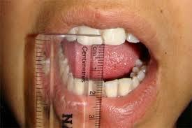 Trismus Nedsat mundåbning (35 mm) Påvirker evnen til at kommunikere, indtage føde, udføre mundhygiejne,