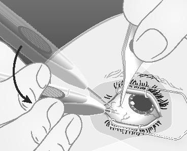 3) Ret derefter kanylen ind mod midten af øjet til corpus vitreum. Dette danner en skrå bane i sclera.