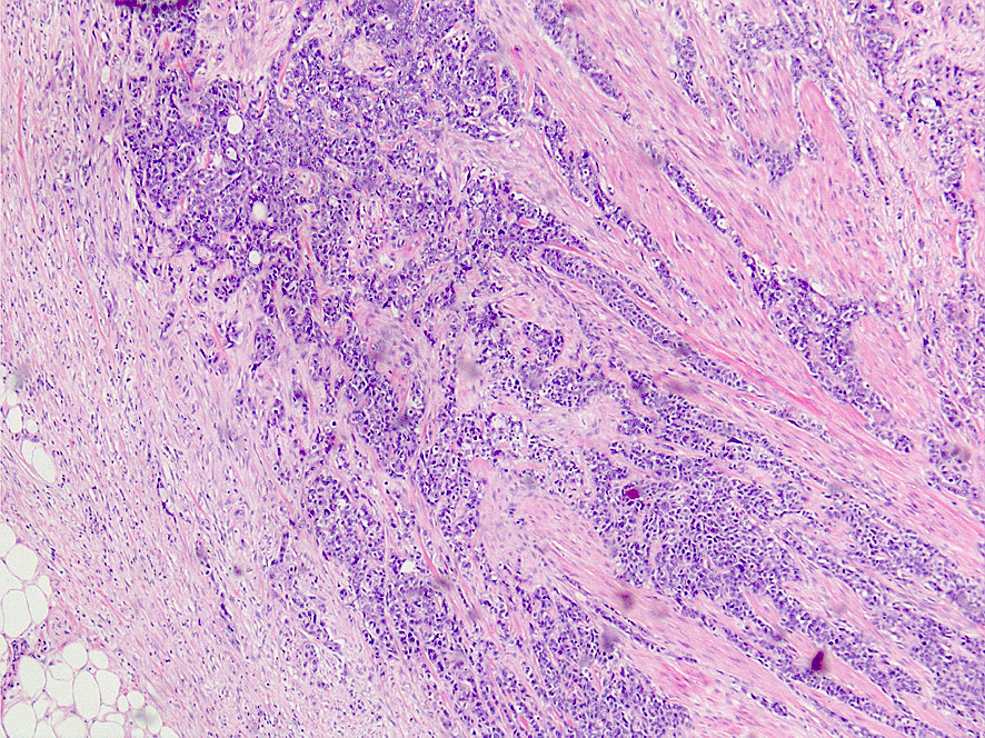 Transitiocellulær papillær/solid tumor, grad