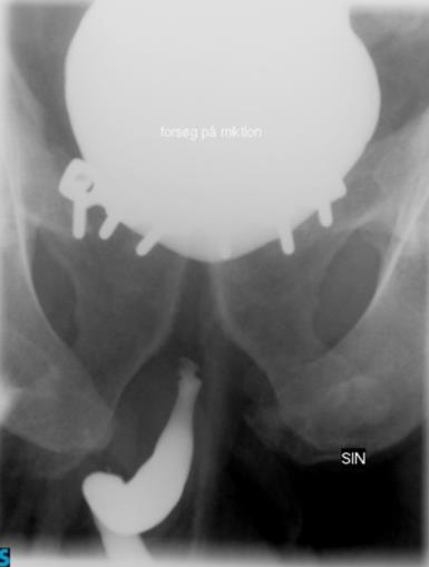 Goldman classification of urethral Injuries