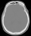 31-1-214 18 F-FDG, PET/ versus PET/CT in brain % difference, PET/ versus PET/CT in brain PET/CT T=17 min kbq/ml 37 22 HU 124 PET/ 17 min PET/CT PET(/) DWFS - PET(/CT) CT 1 PET(/CT) CT -124 CT %