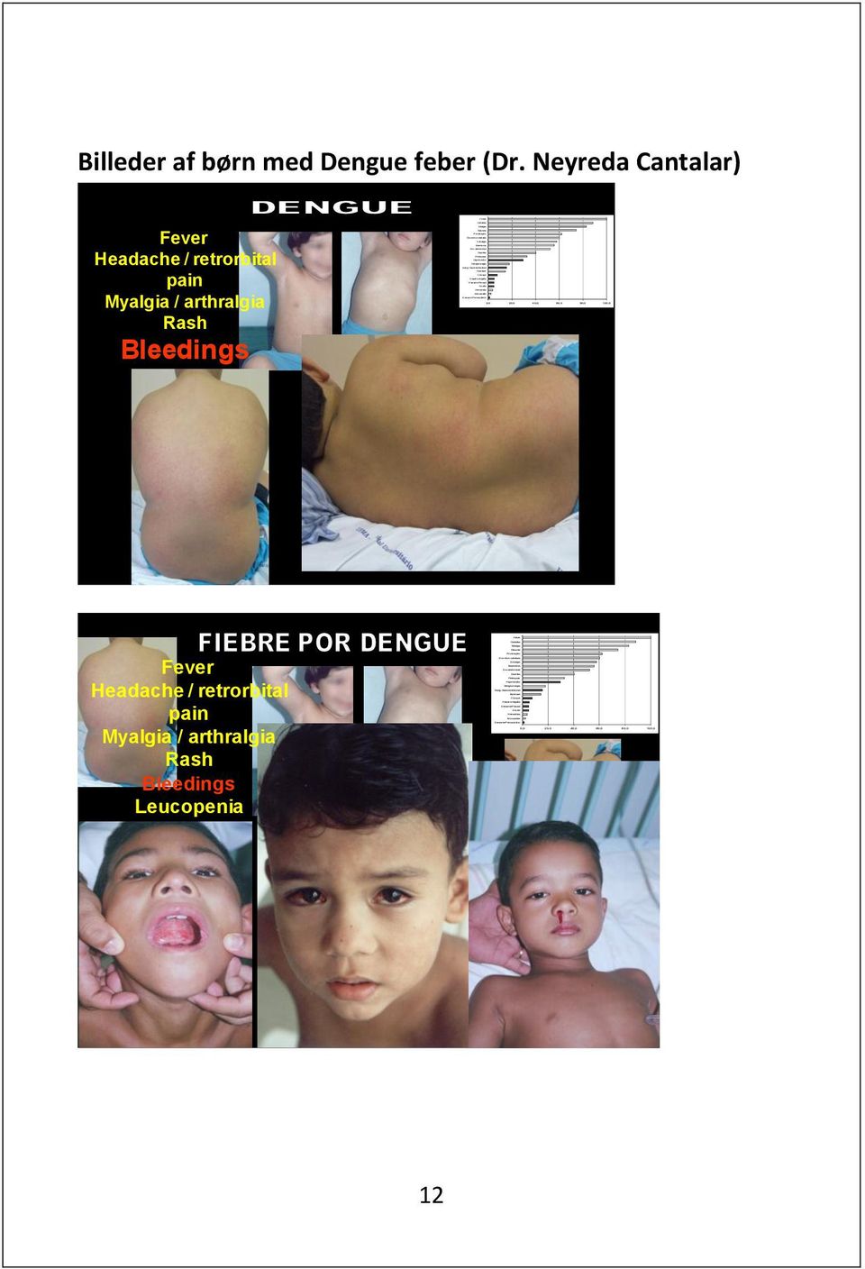 Derrame Pleural Ascite Hematúria Miocardite Derrame Pericavitário 0,0 20,0 40,0 60,0 80,0 100,0 Billeder af børn med Dengue feber (Dr.