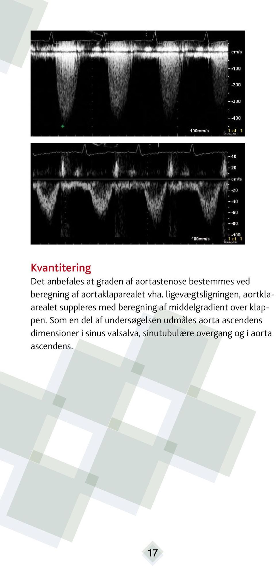 ligevægtsligningen, aortklaarealet suppleres med beregning af middelgradient