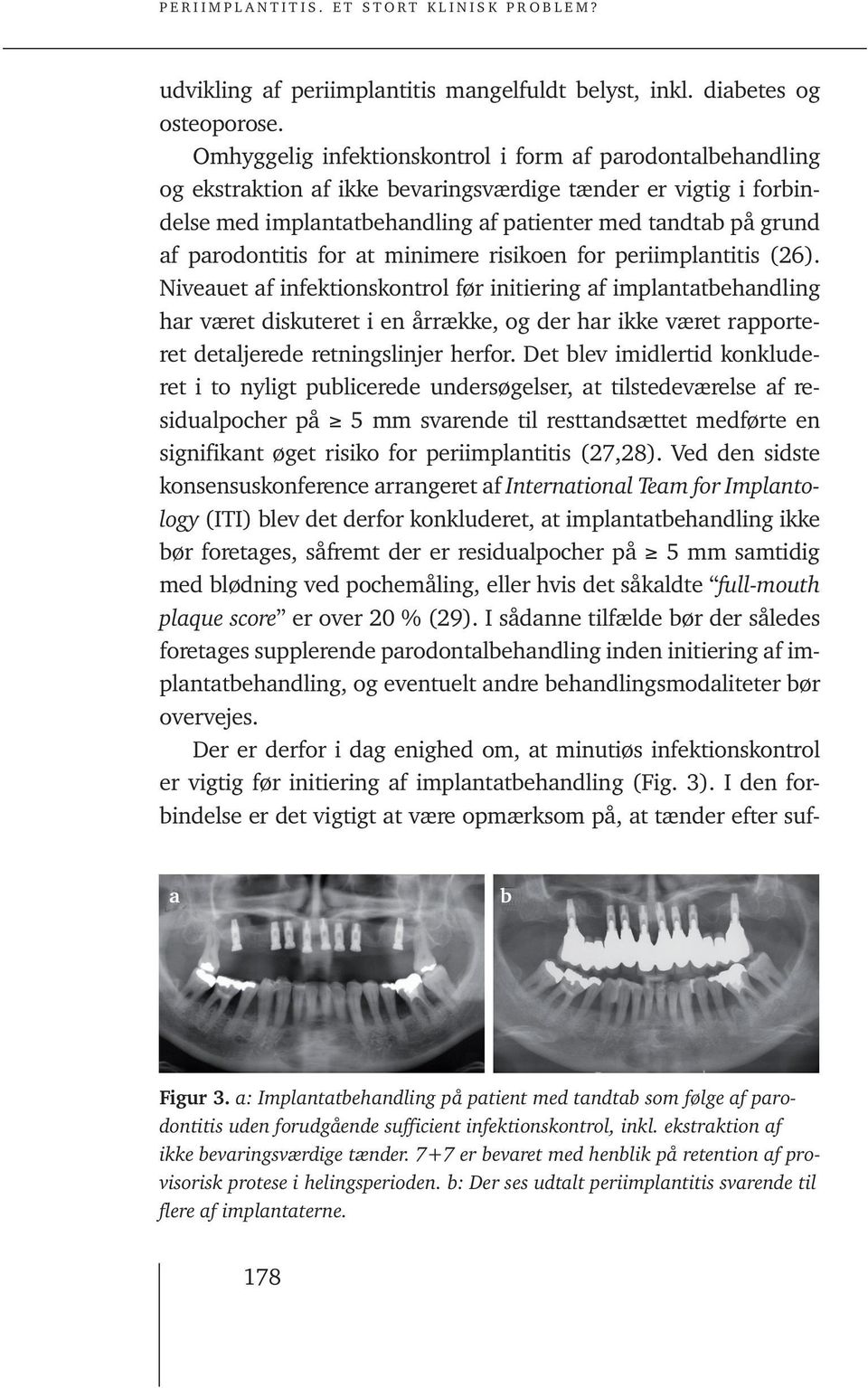 parodontitis for at minimere risikoen for periimplantitis (26).