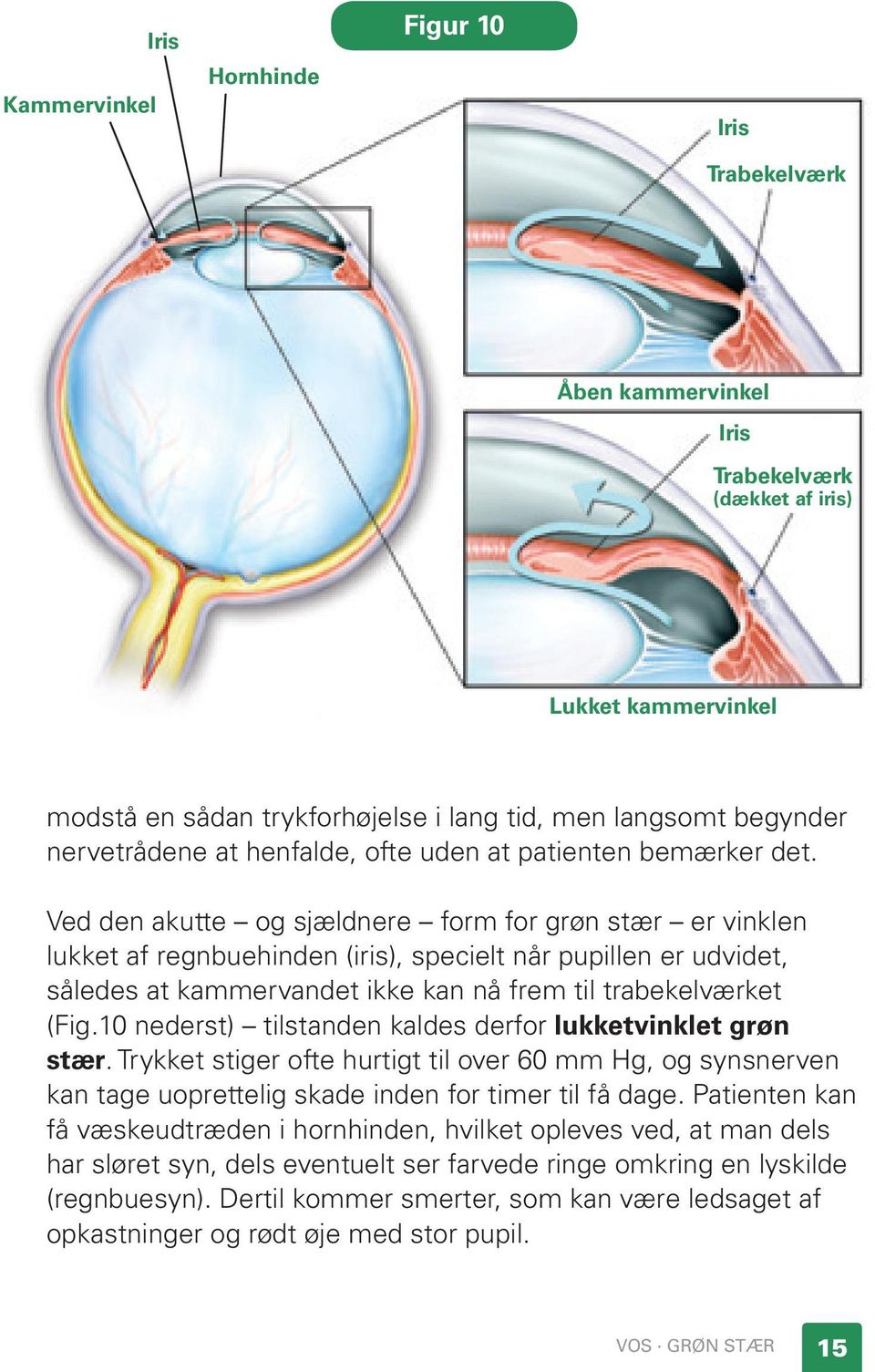 Ved den akutte og sjældnere form for grøn stær er vinklen lukket af regnbuehinden (iris), specielt når pupillen er udvidet, således at kammervandet ikke kan nå frem til trabekelværket (Fig.