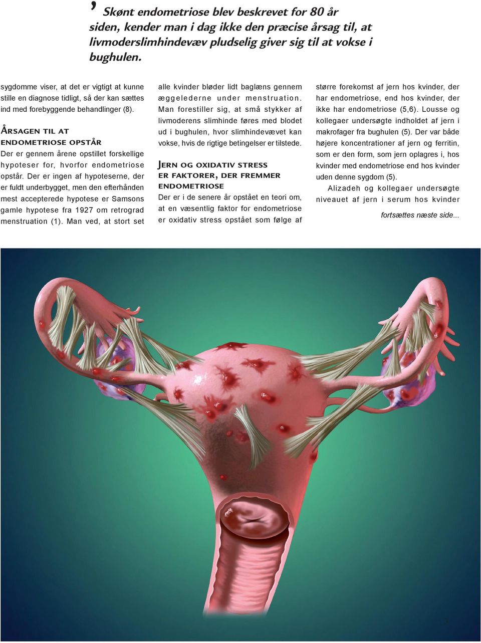 Årsagen til at endometriose opstår Der er gennem årene opstillet forskellige hypoteser for, hvorfor endometriose opstår.