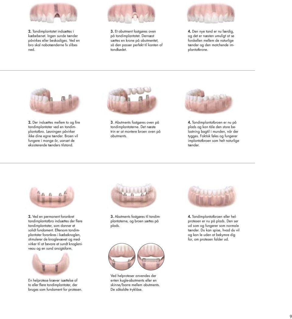 Den nye tand er nu færdig, og det er næsten umuligt at se forskellen mellem de naturlige tænder og den matchende implantatkrone. 2.