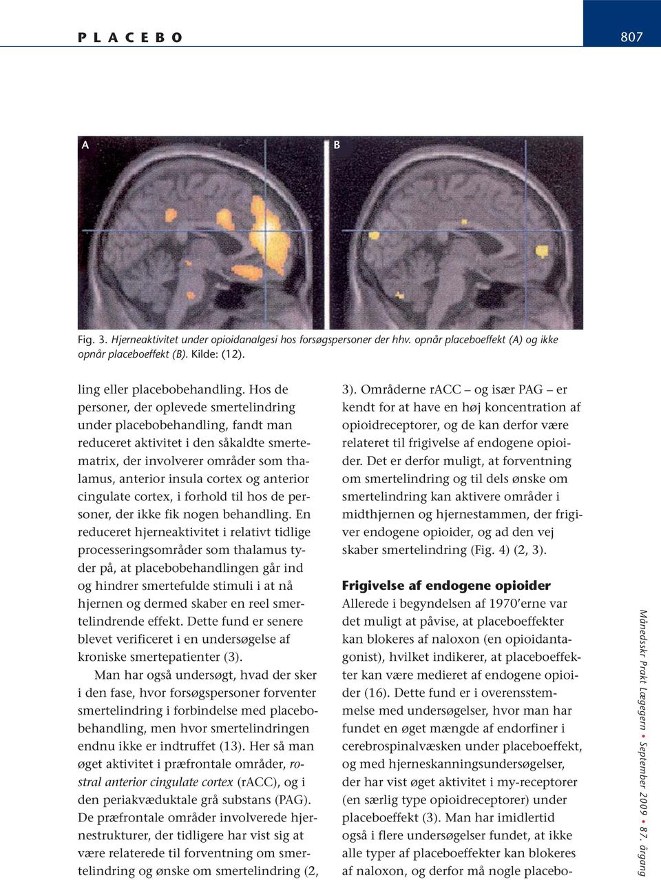 anterior cingulate cortex, i forhold til hos de personer, der ikke fik nogen behandling.
