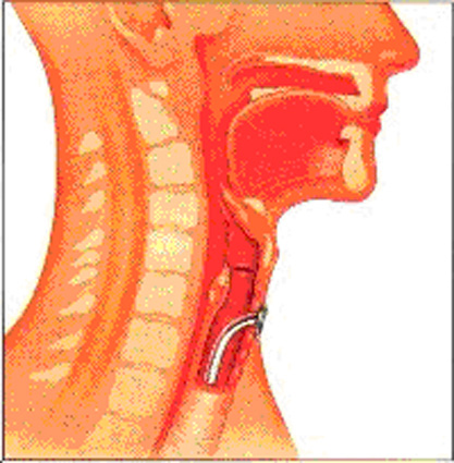 Om operationen At være tracheotomeret vil sige, at du får indsat et rør (en trachealkanyle) fra forsiden af halsen ind i luftrøret.