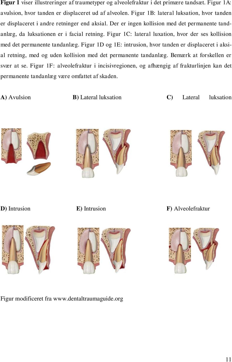 Figur 1C: lateral luxation, hvor der ses kollision med det permanente tandanlæg.