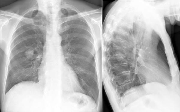 Fibrene fortsætter med at skade lungerne i mange år efter eksponeringen er ophørt. Billede af sund lunge.