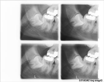 for Oral Radiologi Tandlægeskolen (bla. Eur Guidelines 2004) 9/74 Mesio/Kraniel Orto/Kraniel Roden af -8 ligger bukkalt for can. mand.