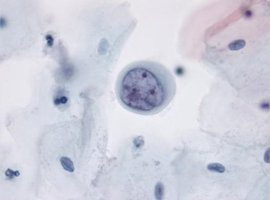 Konklusion MGH kan ses som glandulære celler med varierende atypi men der
