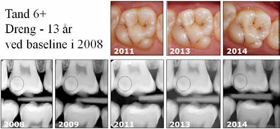 Plastforsegling af dentincaries VIDENSKAB & KLINIK Seks års kontrolundersøgelser af plastforseglet 6+ hos en 3årig dreng Tand 6+ Dreng 3 år ved baseline i 2008 Fig.