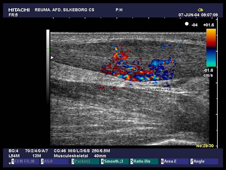Fig?: Ultralydscanning af Achillessene. Senen er tenformet fortykket.