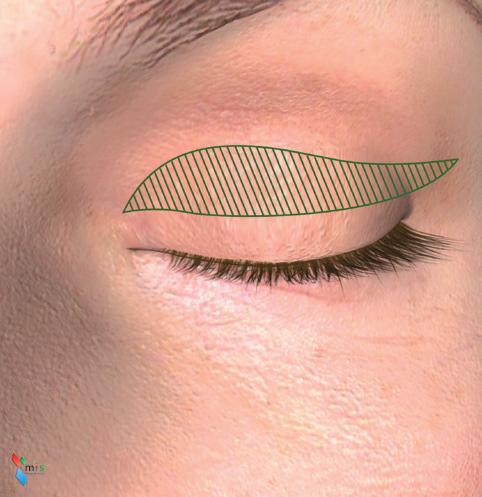 Overskydende hud markeres Overskydende hud, muskel og fedt fjernes Såret syes med fin tråd vi, om en korrektion af øjenlågene er det rette for dig.