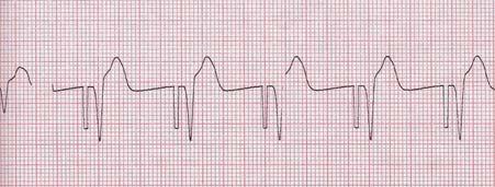 Inverteret T-kurve/manglende P-kurver Pacermarkører Det kan nogle gange være nyttigt at skifte EKG-afledninger og -størrelse ved bestemmelse af indfangning. Bemærk!