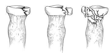 1) Hvis rtg. efter reponering viser albuen på plads uden frakturer eller afsprængninger er behandlingen vinkelgipsskinne i 2 uger.