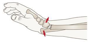 Underarm F. corporis antebrachii Udisloceret/vinkling <10º knoglekontakt i begge underarms knogler: Høj vinkelgipsskinne i 4-6 uger.