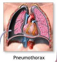 Thorax traumer F. costae DS 22.3 Klinisk diagnose. Rtg af thorax ved mistanke om pneumothorax Ved > 3 frakturer kontakt til Thoraxkir. Afd. M.h.p. tilbud om indl. anlæggelse af epii-kat. Obs.abd.