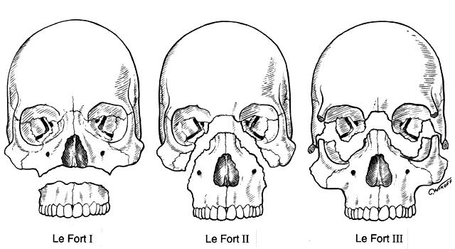 Fornemmelse af ændret sammenbid kan være tilstede Yderligere udredning: CT af ansigtsskelettet.