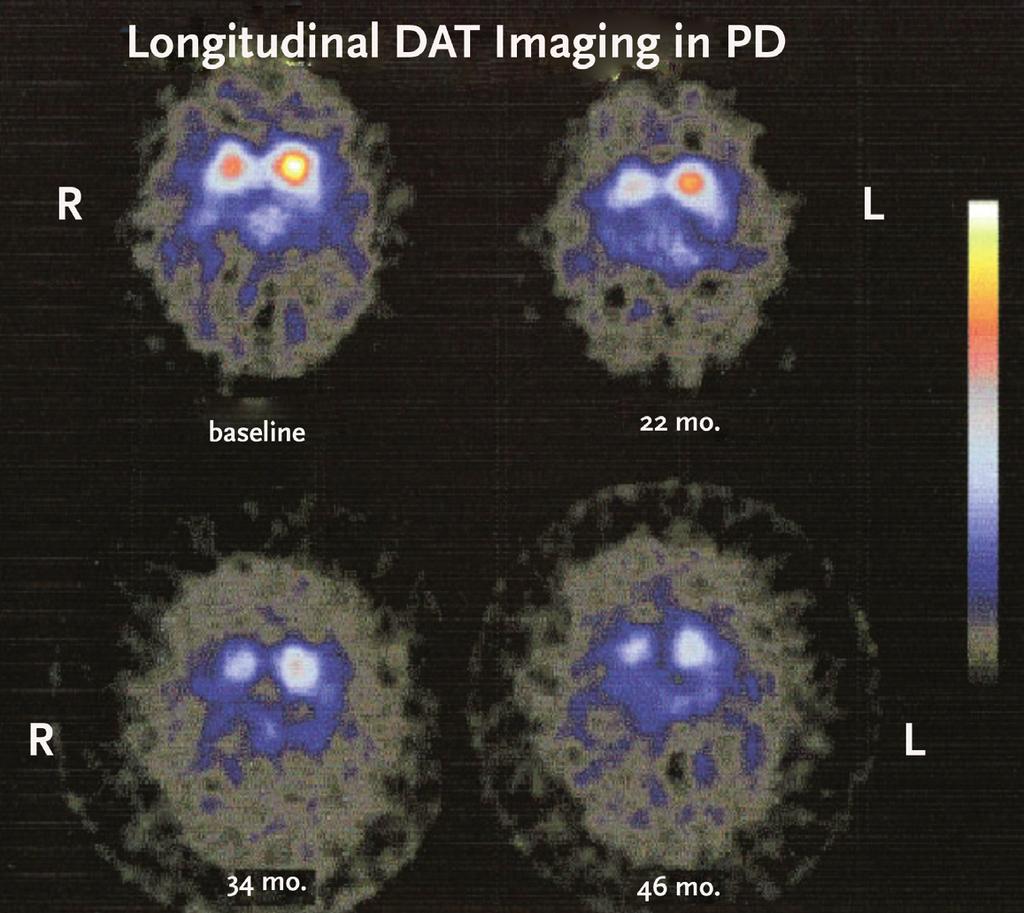 såkaldt gammakamera. Man kan se lyse pletter inden for det kamerafelt, der kommer fra hjernen, og kan på denne måde vurdere antallet af dopaminnerver i basalganglierne.