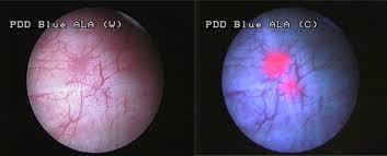 Photodynamisk diagnostik PDD - Optisk teknik, der fremhæver tumordetektion og resektion.