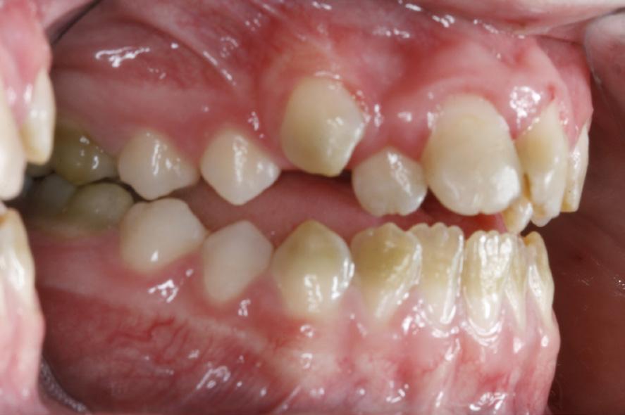 Der ses en tydelig overgang mellem dentalt væv dannet før hhv. efter levertransplantationen (1,5 år).