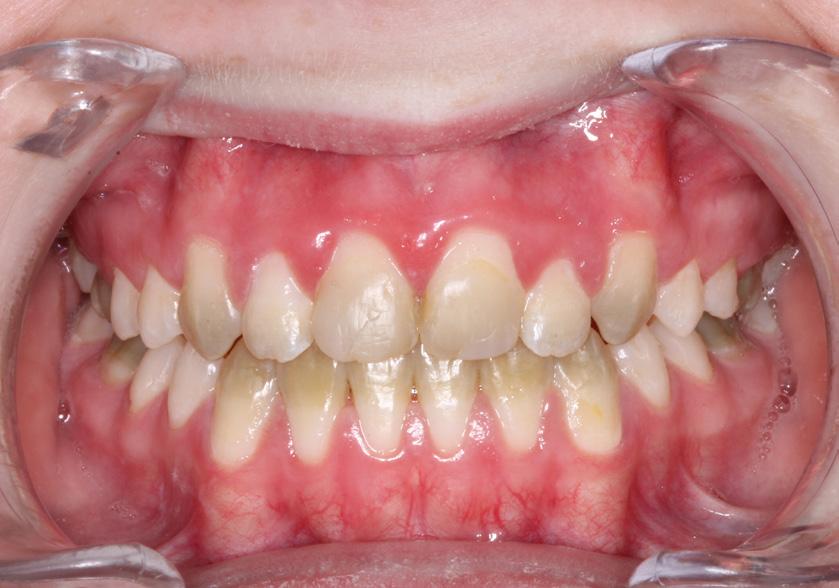 Galdevejsobstruktion grønne tænder VIDENSKAB & KLINIK med plast, facade- eller kronebehandling med bidhævning til følge.