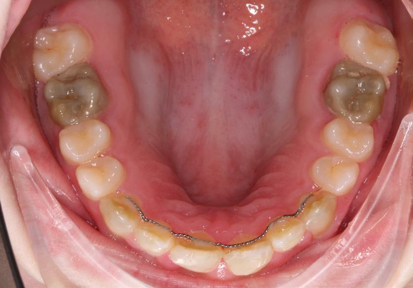 Misfarvningerne forårsager kosmetiske gener for patienter, men lader ikke til at påvirke funktion eller at øge risikoen for udvikling af dentale eller parodontale sygdomme.