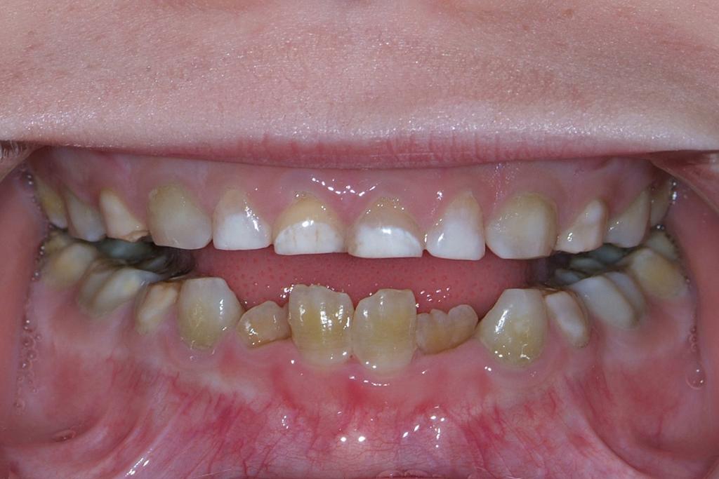 Patienttilfælde 2, 6,5 år gammel Patienttilfælde 2, 16 år gammel Fig. 4. Hele det primære tandsæt er misfarvet. I underkæben ses, at de permanente incisiver også er afficeret.