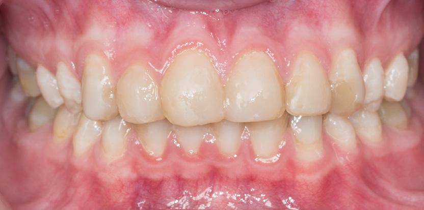 Discoloration is covered with composite across the front from canine to canine in both upper and lower jaw. When the patient has grown up, a more permanent prosthetic treatment will be undertaken.