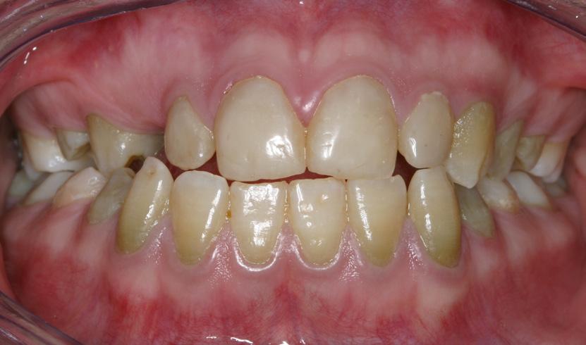 Galdevejsobstruktion grønne tænder VIDENSKAB & KLINIK Patienttilfælde 3, 14,5 år gammel Behandlingsresultatet for patienttilfælde 3 Fig. 7. Alle frembrudte tænder er påvirkede, men i varierende grad.