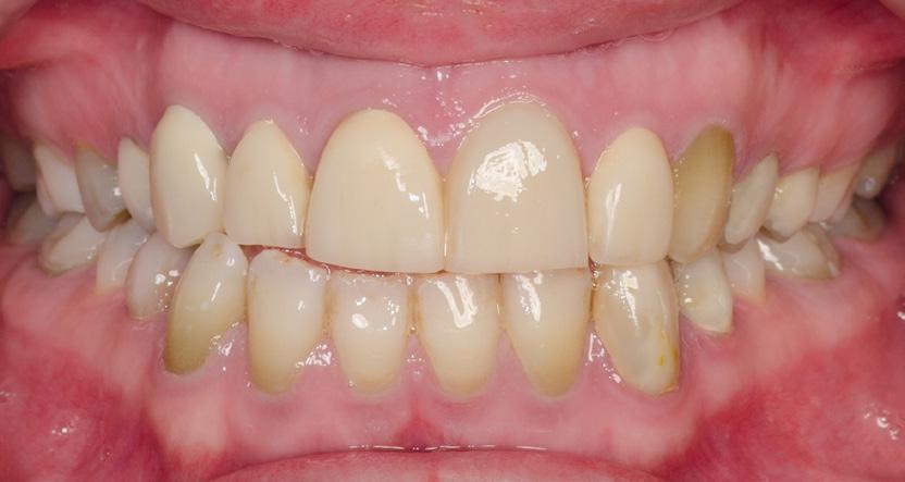 The upper incisors have been covered with composite. Liver transplantation at 5.5 years. næmien. Dette svarer til de tidspunkter, hvor patienterne gennemgik en levertransplantation: hhv.