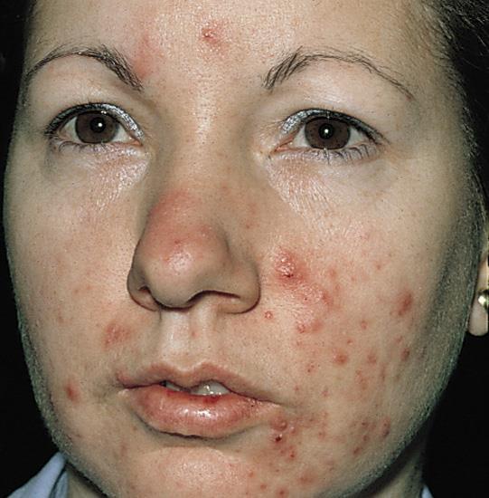 Moderat acne Behandling: lokal og