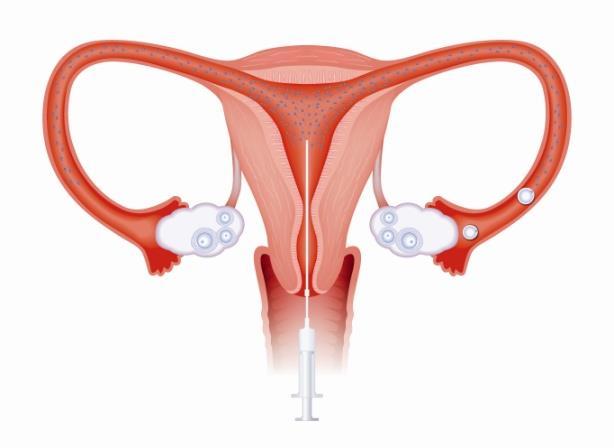 3 Insemination med partners sæd - IUIH Betingelser for behandlingen hos CFC er: At kvinden har ægløsning, uanset om den kommer af sig selv eller efter hormonbehandling.