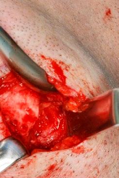 Med stump dissektion blev platysma og halsfascien gennemskåret til periost under hensyntagen til nervus facialis ramus marginalis, hvorefter der blev skåret skarpt igennem periost.