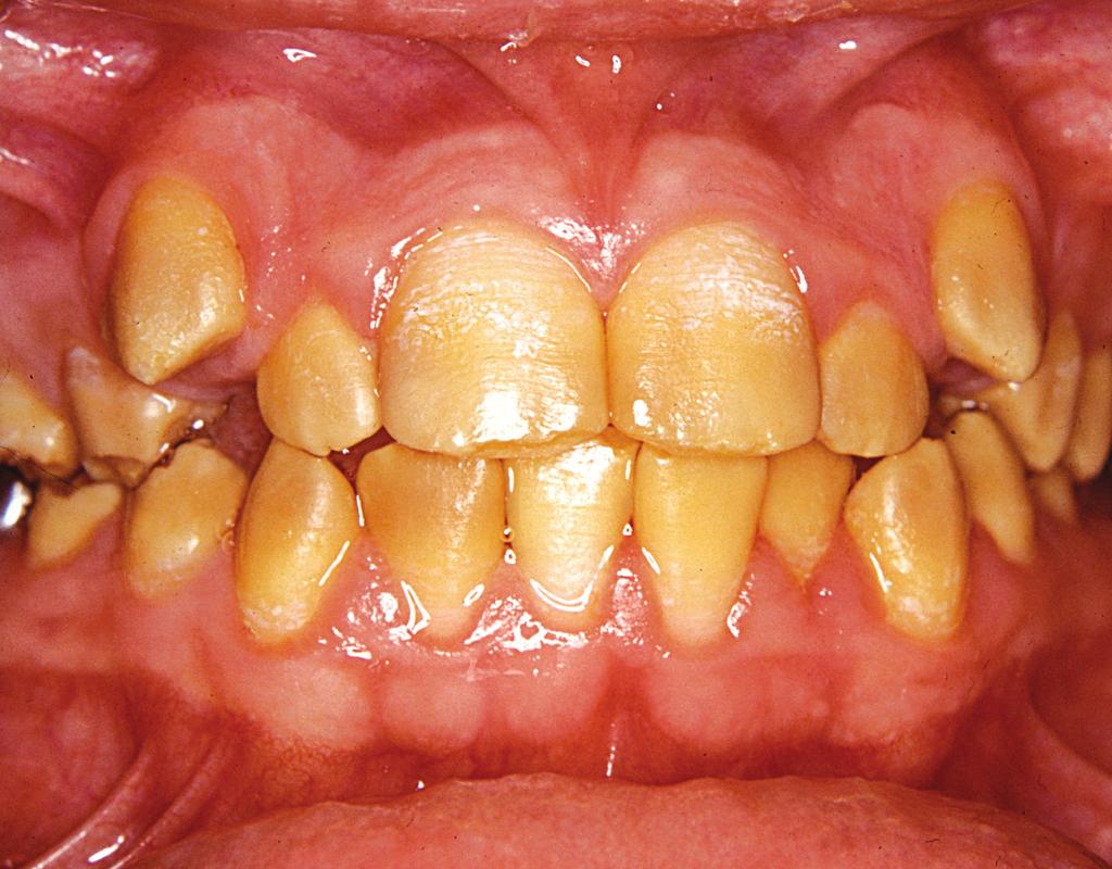 røntgenkontrast. Tænderne er meget temperaturfølsomme, hvilket ofte medfører insufﬁcient plakfjernelse og efterfølgende dannelse af store mængder supragingival tandsten.