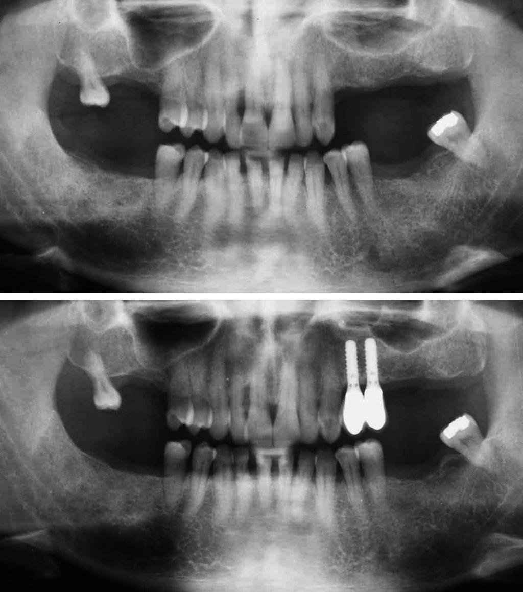 126 VIDENSKAB & KLINIK Kontrol og vedligehold efter behandling Patienter, der har vist sig modtagelige for parodontitis, har selv efter sufficient behandling stor risiko for, at sygdommen opstår igen.