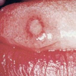 Blist på tungen Symptomer: Blister kan sidde på kindens slimhinde, på indersiden af læberne i bunden af munden eller på tungen, og optræder oftest enkeltvis.