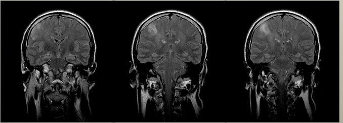 Bevidtshedstab Anamnese Undersøgelse CT-Scan Blodprøver Lumbalpunktion EEG cmrt EKG Glucose