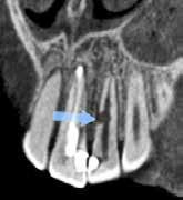 resorption was not clearly visible (B). A B Fig. 4.